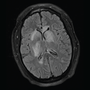 T2/FLAIR: Hyperintensities of the caudate nucleus with mild mass effect. 