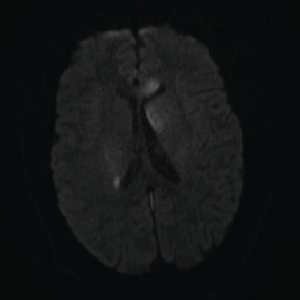 DWI: Extensive areas of restricted diffusion extending to the periventricular white matter along the lateral ventricles. 