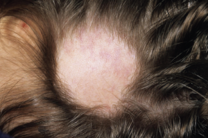 Hair loss is commonly seen in lupus patients, but not all alopecia types are the same.