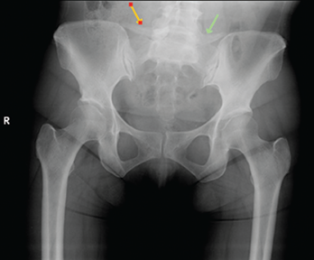 A pelvic X-ray had shown sacroiliac joint osteoarthritis and enthesopathy.