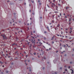 Renal biopsy showing class III lupus nephritis with rare foci of subendothelial deposits (wire loop lesions).