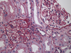 Renal biopsy showing class III lupus nephritis with rare foci of subendothelial deposits (wire loop lesions).