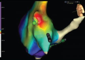 Figure 5: Activation Mapping of the Right Atrium