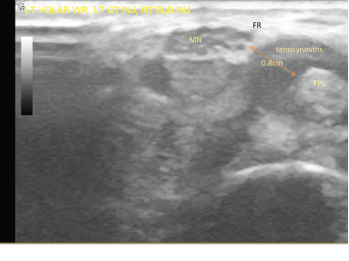 Figure 2: The patient’s left volar wrist ultrasound, transverse view (MN = median nerve; FPL = flexor pollicis longus; FR = flexor retinaculum)