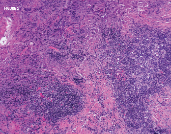 Figure 2: A nasal biopsy of a mass lesion showed lymphoid aggregates (abundant plasma cells) and dense fibrosis. Histopathologic image courtesy of Dr. Paul Cohen, Yale University.