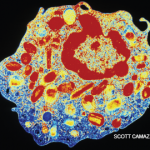 Case Report: Skin-Deep Eosinophils