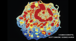 Case Report: Skin-Deep Eosinophils