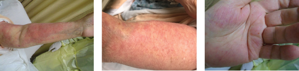 Images 1, 2 & 3: The patient’s examination revealed a diffuse morbilliform rash.