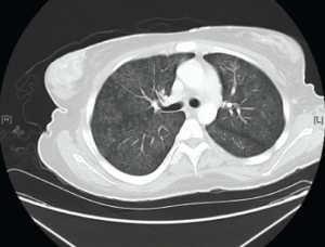Figure 2. Diffuse bilateral groundglass opacities were seen throughout the lung parenchyma.