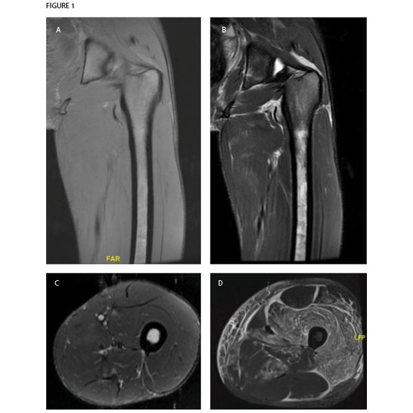 Magnetic resonance imaging of patient’s left thigh. Coronal sections of (A) T1-weighted and (B) T2-weighted sequences both demonstrate extremely thin layer of subcutaneous fat, also seen in the (C) axial section section of STIR sequence imaging. The muscle parenchyma does not have any regions of high T2 signal intensity to suggest muscle edema, as is seen in an axial STIR image from a representative patient with dermatomyositis (image courtesy of Simon Helfgott, MD) (D). The patient’s bone marrow has low T1 and high T2 and STIR signals in the diaphysis of the femur, consistent with serous atrophy. Normal bone marrow has high T1 signal and low T2 and STIR signals.