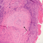 Figure 1. A nasal biopsy shows intimal infiltration of the small blood vessels (black arrow).