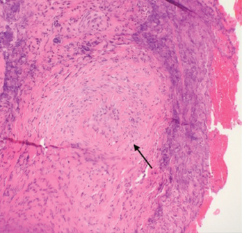 Figure 1. A nasal biopsy shows intimal infiltration of the small blood vessels (black arrow).
