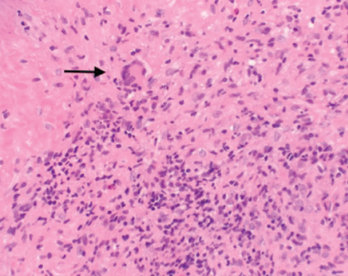 Figure 2. A nasal biopsy shows giant multinuclear cells (black arrow).
