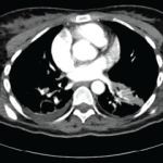 Submassive pulmonary embolism. Filling defects seen in the pulmonary artery.