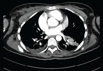 Submassive pulmonary embolism. Filling defects seen in the pulmonary artery.