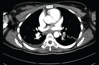 Submassive pulmonary embolism. Filling defects seen in the pulmonary artery.