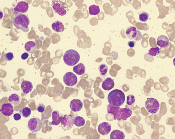 Eosinophilia