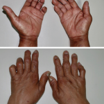 Figures 1 and 2: These images shows the patient’s bilateral ulnar deviation and benediction deformity of the left hand.