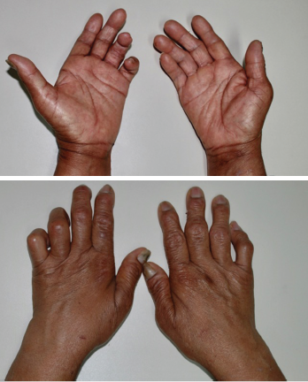 Figures 1 and 2: These images shows the patient’s bilateral ulnar deviation and benediction deformity of the left hand.