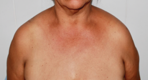 Figure 3: This image shows the patient’s symmetric shoulder dislocations.