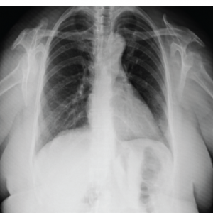 Figure 4: This chest X-ray reveals the dislocation of both humeri. 