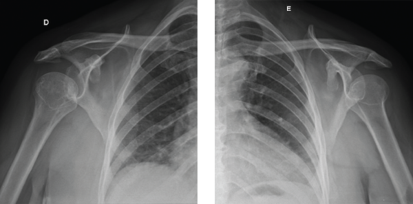 Figures 5A and 5B: These X-rays show incipient reabsorption of the ends of the humeri without the prominence of osteophytes and osteosclerosis. 