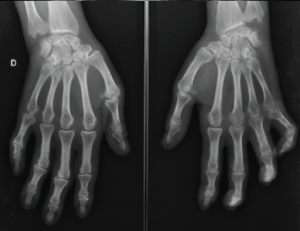 Figure 6: This X-ray shows degenerative changes on the proximal and distal interphalageal joints and bone reabsortion at the fifth metacarpophalangeal joint of the left hand.