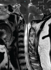 Figure 7: An MRI of the patient’s spine and head confirmed an extensive syringomyelia secondary to Chiari type I malformation. 