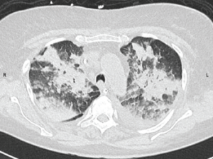 Figure 1: CT Scan of the Chest