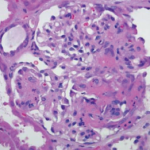 Figure 2: Renal Biopsy