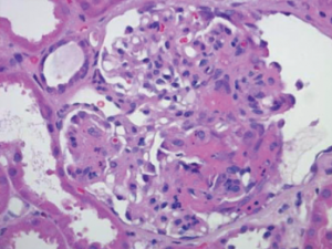 Figure 2: Renal Biopsy