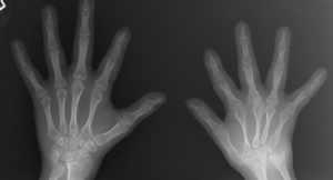 How Does Down Syndrome Affect Musculoskeletal Health?