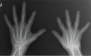 Figure 1: An X-ray of the hands, showing extensive erosion over the ulnar styloid, carpal bones and the carpometacarpal joints of the right side (A), along with abnormal shortening and thinning of diaphysis over the right second through fourth metacarpal bones (B). The X-ray of the left hand appears normal.