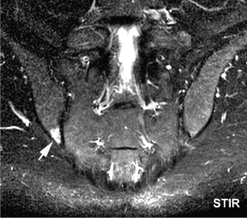 Bone marrow edema in the inferior posterior ilium, the single most affected SIJ region in athletes, is shown.