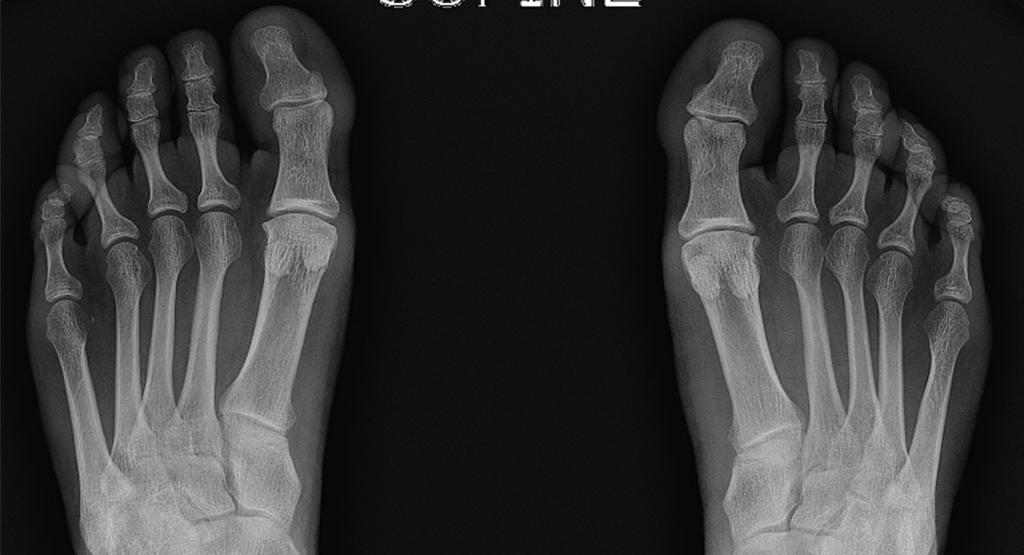 Figure 4. Bilateral feet radiographs appear normal except for subtle spurring at the bilateral first proximal interphalangeal joints.