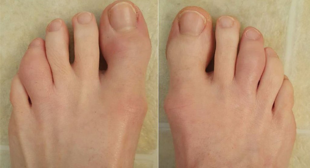 Acute dactylitis of the left fourth and right third toes.