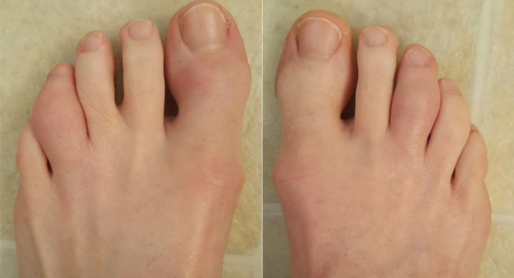 psoriatic arthritis toes