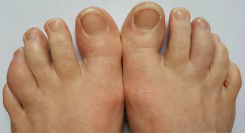 Figure 2. Improving dactylitis at the left fourth and right third toes. 
