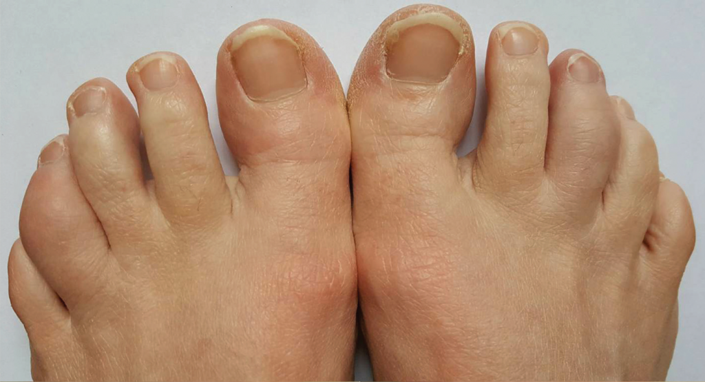 psoriatic arthritis toes