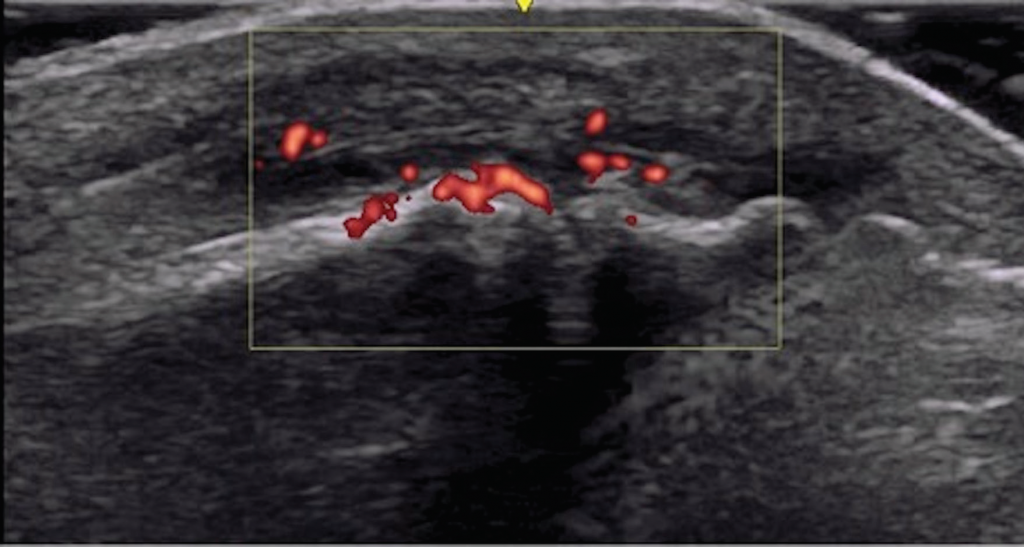Figure 3. Interphalangeal (IP) toe joint with extensor tenosynovitis and IP synovitis with Doppler enhancement. 