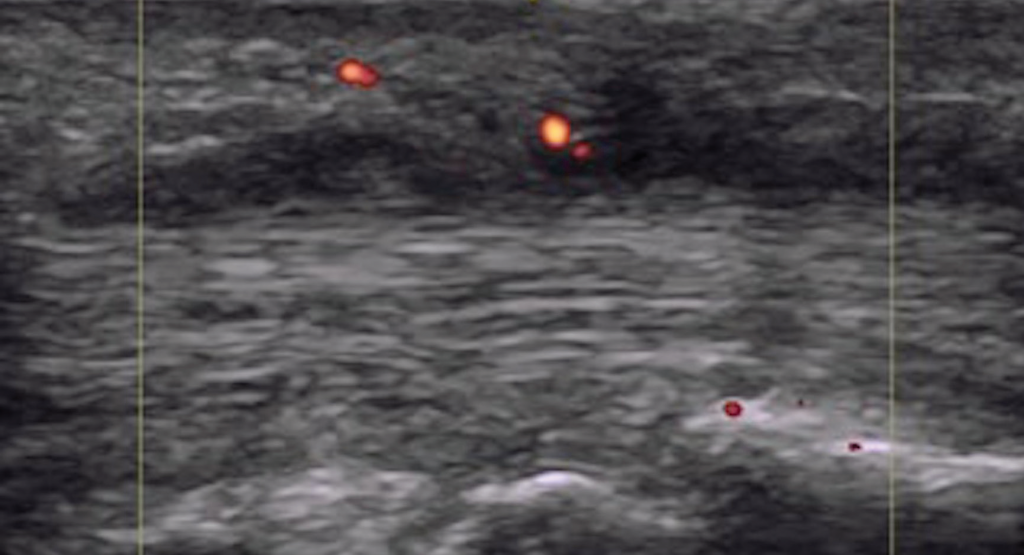 Figure 5. Dactylitis with flexor tenosynovitis and tendon Doppler enhancement.