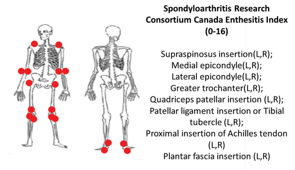 SMC Arthritis Forum/Dr.Hanady Manasfi on X: Comparison #BASDAI and #ASDAS  #spondyloarthtopathy #EULAR2020  / X