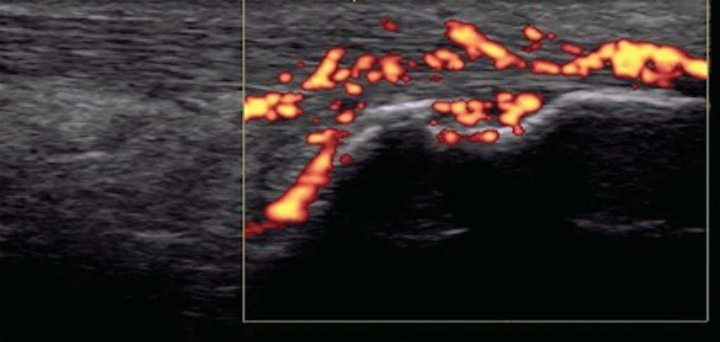 Figure 7. Achilles tendon enthesitis with active Doppler; erosion of calcaneus.