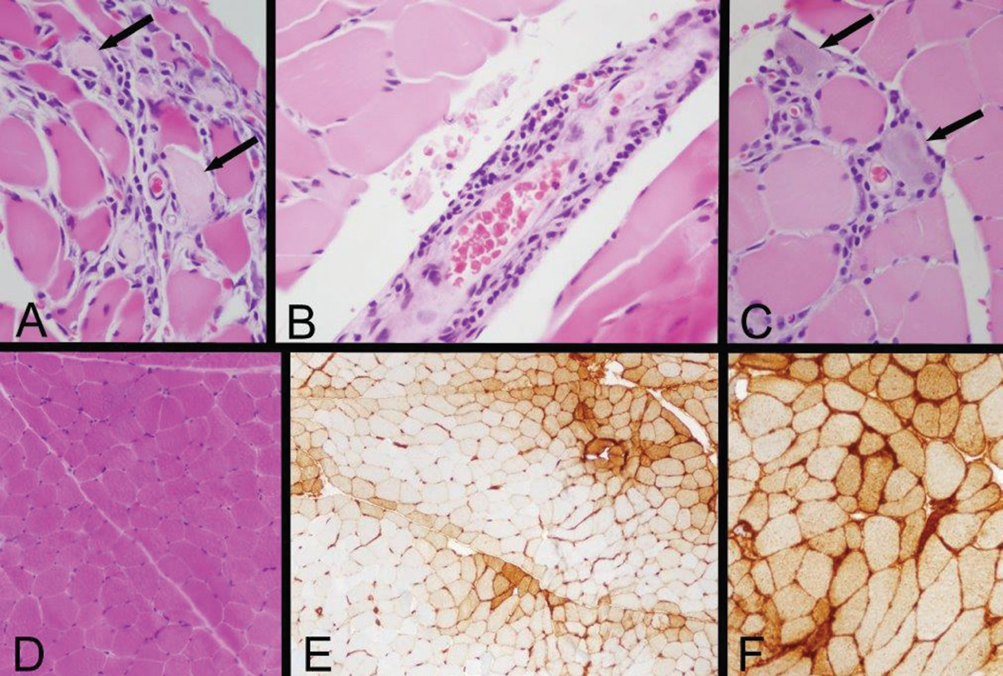 Figure 2: Left Quadriceps Muscle Biopsy