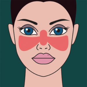 Lupus often presents with a butterfly rash.