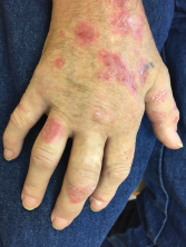 Eleven months following treatment initiation with nivolumab, a 61-year-old male developed a flare of skin psoriasis, as well as swelling and pain in multiple joints.