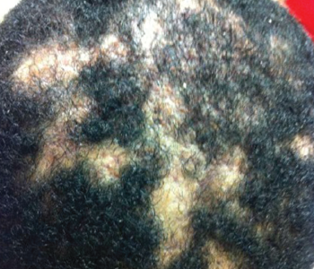 Dissecting cellulitis of the scalp. Note the areas of alopecia where subcutaneous abscesses are located. 