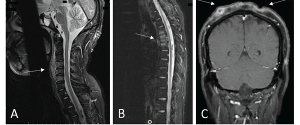 (A) An MRI of the cervical spine revealed multilevel, anterior-predominant, marrow edema extending from C3–C7 with paravertebral edema anteriorly (see white arrow). (B) An MRI of the thoracic spine revealed marrow edema of T3–T5 with mild anterior, superior corner erosion of T5 (see white arrow). (C) An MRI of the brain revealed no intracranial lesions, but note the obvious cellulitis and abscess formation on the scalp (see white arrows). 