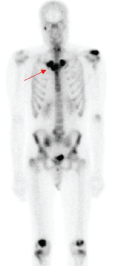 A whole-body bone scintigraphy revealed the pathognomonic finding of the bull’s head enhancement correlating with osteitis of the sterno-manubrio-clavicular articulations bilaterally (see red arrow). You can also see the enhancement in the spine, both knees, left shoulder and right maxillary/mandibular regions. 
