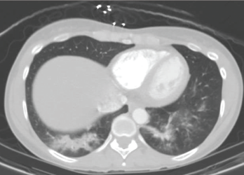 A CT scan of the chest performed in the emergency department shows bilateral infiltrates of the lower lobes.